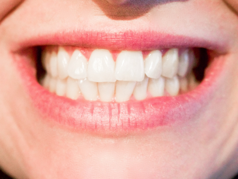 Bleaching-Produkte mit Wasserstoffperoxid: Vorsicht nach Wurzelbehandlung!