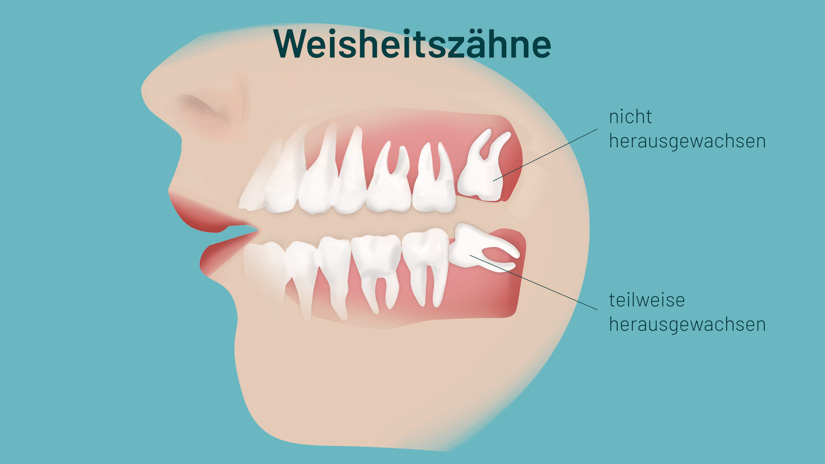 Weisheitszähne entfernen? Auf den Einzelfall kommt es an