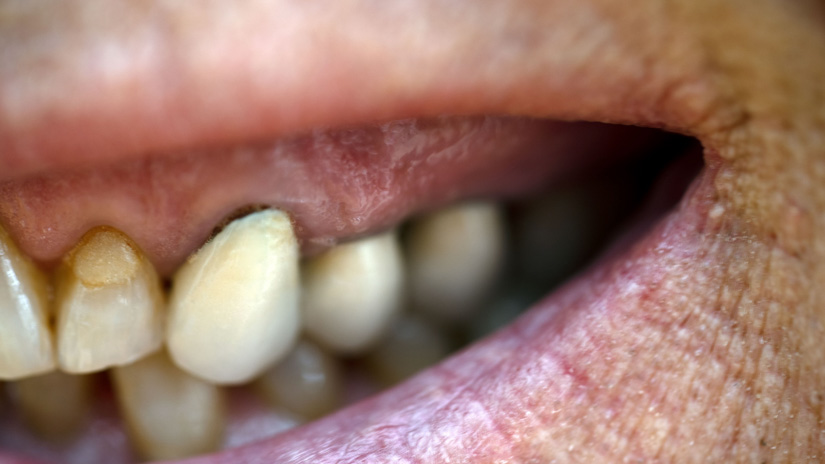 Patienteninfo: Achtung, Zahnfleisch geht zurück - dunkle Ränder an Zahnkronen