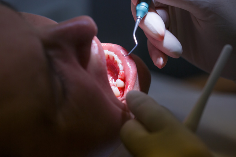 Neue Leistungen zur systematischen Parodontitis-Behandlung einvernehmlich beschlossen