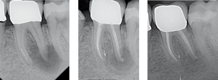 Moderne Endodontologie für den Allgemeinpraktiker