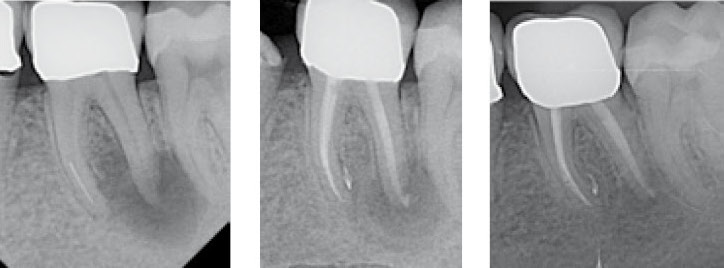 Moderne Endodontologie für den Allgemeinpraktiker Moderne Endodontologie für den Allgemeinpraktiker