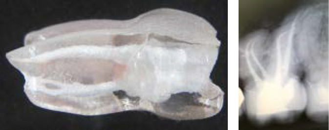 Anatomoforme Wurzelkanalaufbereitung und Obturation Anatomoforme Wurzelkanalaufbereitung und Obturation